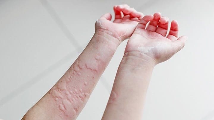 لکه های قرمز روی پوست بدون خارش